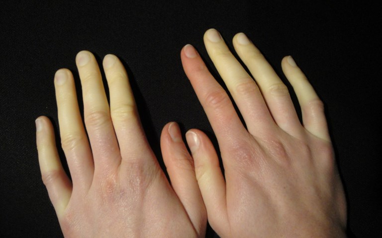 Losing grip Losing grip